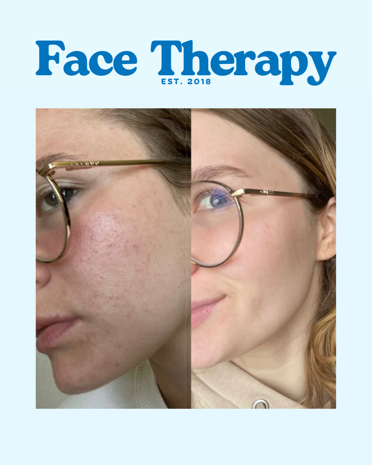 Face Lift Wand™